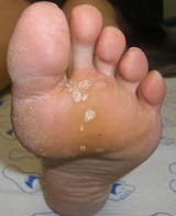 Plantar Warts on the foot